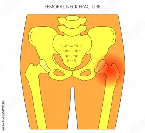 Vector illustration of healthy human hip and femoral neck fracture without dislocation. For advertising and medical publications