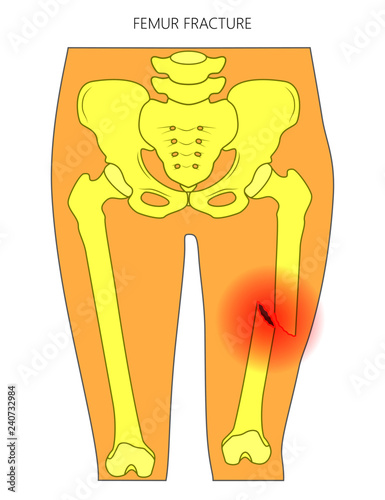 Vector illustration of a human pelvis and hip with femur shaft fracture (broken thighbone). Front view. For advertising and medical publications.