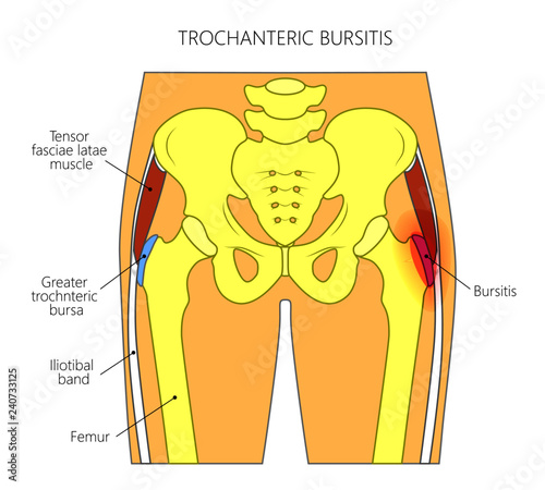 Vector illustration of a human pelvis and hip with pain in the hip joint and trochanteric bursitis. Front view. For advertising and medical publications.