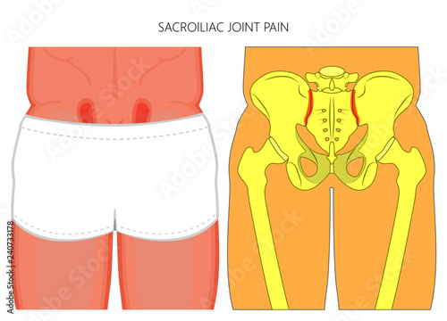 Vector illustration of unhealthy human pelvis with sacroiliac joint pain or injury.  For advertising and other medical publications