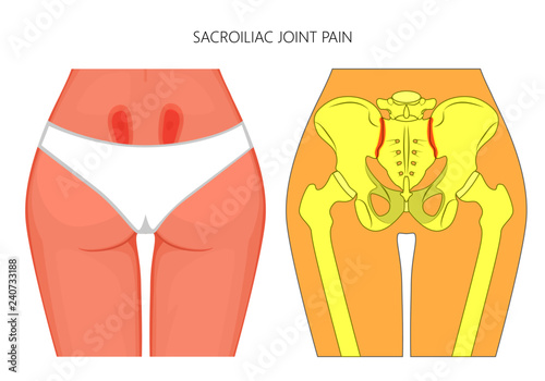 Vector illustration of unhealthy human pelvis with sacroiliac joint pain or injury.  For advertising and other medical publications