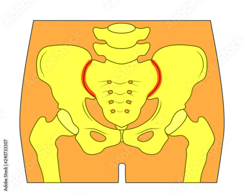 Vector illustration of unhealthy human pelvis with sacroiliac joint pain or injury.  For advertising and other medical publications
