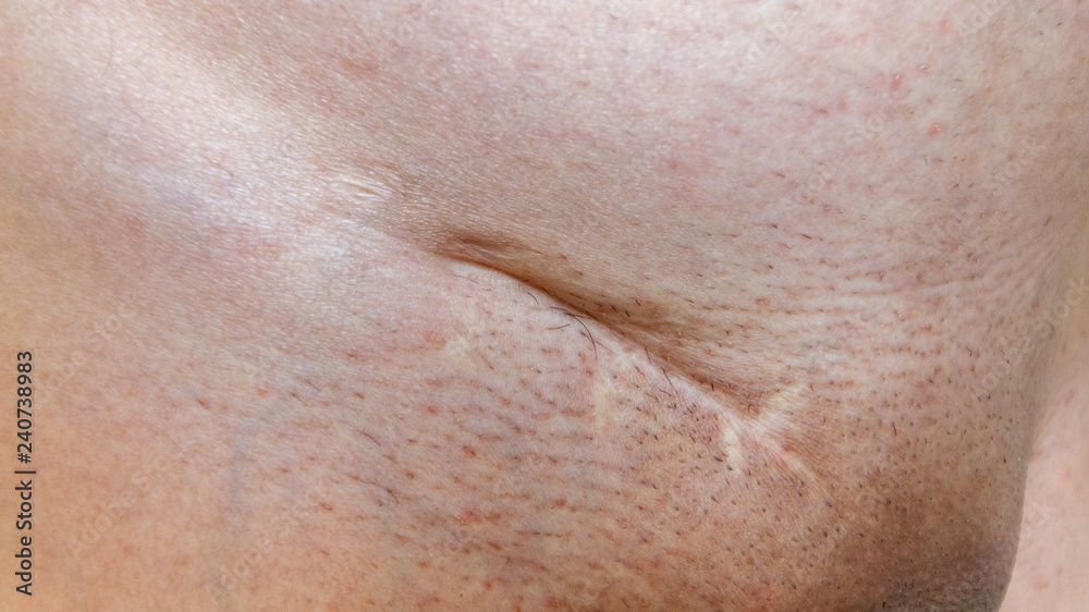 Naklejka premium Surgical scar in lower abdomen