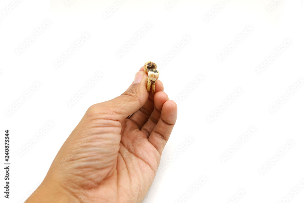 Close-up Of Man Hand Holding Decay Tooth