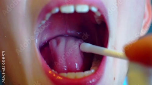 sore mouth and throat are treated with medication as a spray.close-up photo