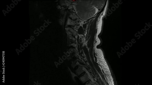 rx animazione risonanza magnetica rachide cervicale photo