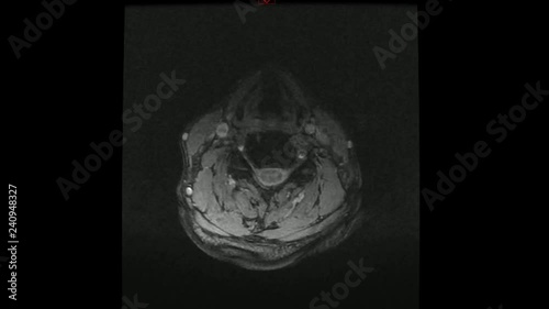 TAC tomografia assiale computerizzata cervicale photo
