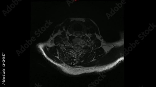 TAC tomografia assiale computerizzata cervicale photo