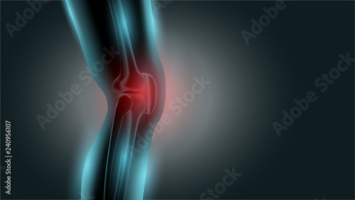 Knee pain x ray. Healthy joint and unhealthy painful joint with osteoarthritis.