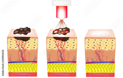 Removal of birthmarks, popiloma, wart laser. The structure of moles on the skin. Infographics. Vector illustration on isolated background.