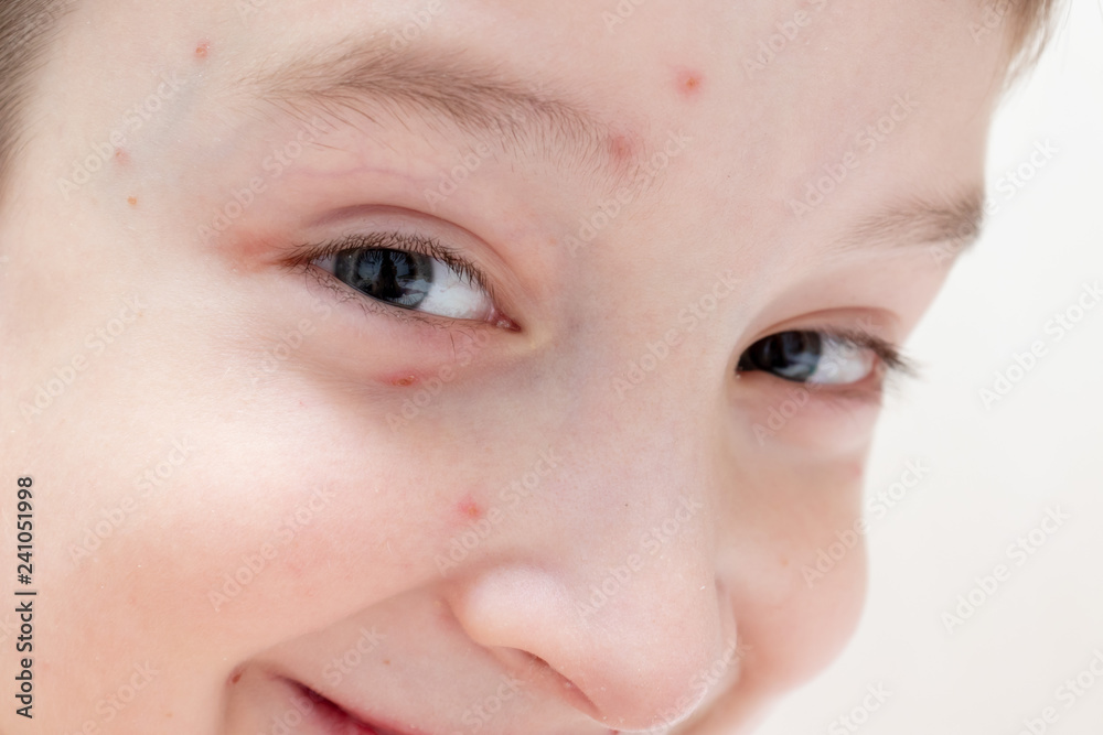 Face of smiling caucasian boy with Varicella virus or Chickenpox, child with bubble rash close up. Dermatology and pediatrics concept. Face of smiling caucasian boy with Varicella virus or Chickenpox, child with bubble rash close up. Dermatology and pediatrics concept.