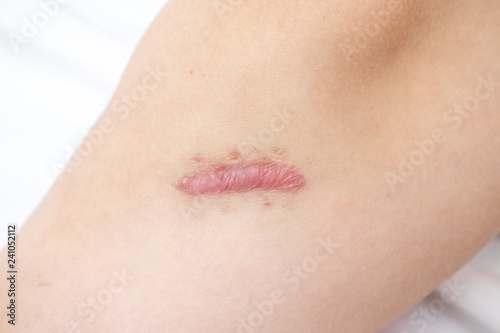 Close up of cyanotic keloid scar on leg caused by surgery and suturing, skin imperfections or defects. Hypertrophic Scar on skin, dermatology and cosmetology concept