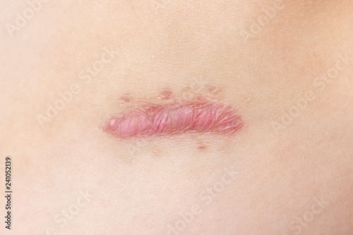 Fototapeta Close up of cyanotic keloid scar caused by surgery and suturing, skin imperfections or defects