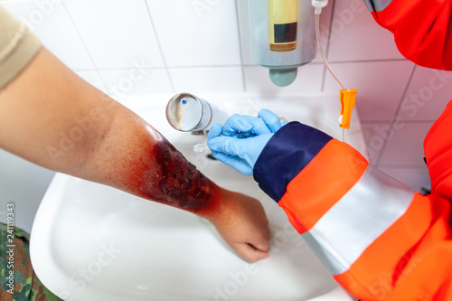 Paramedic cools a make up burn wound