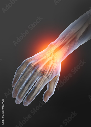 Osteoarthritis, painful wrist joint, 3D illustration