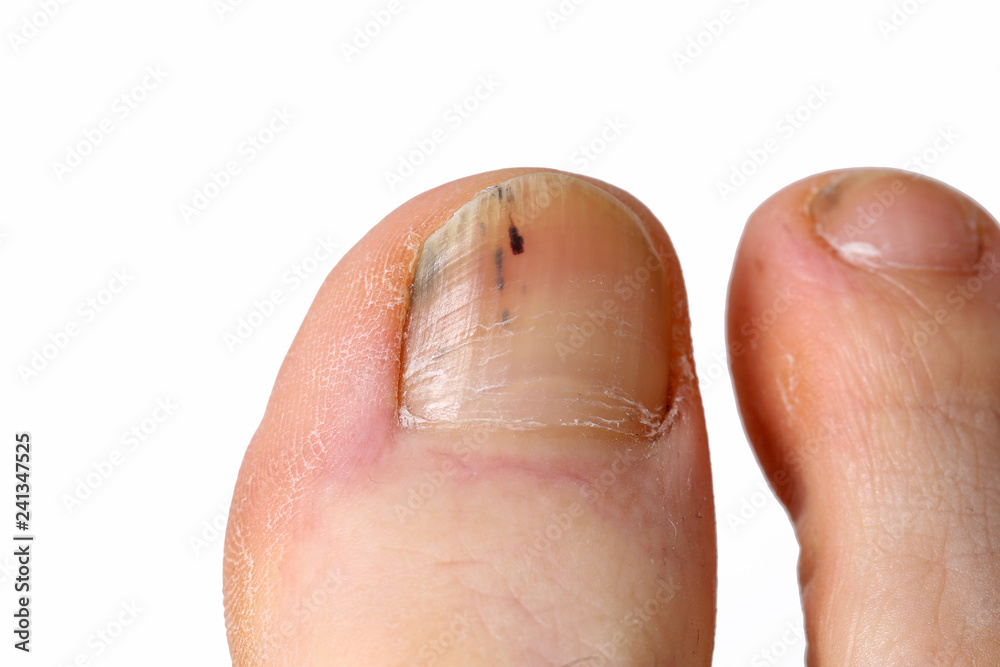 Subungual hematoma on the toe is associated with various diseases Subungual hematoma on the toe is associated with various diseases
