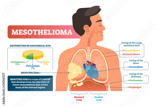 Mesothelioma vector illustration. Labeled lung cancer educational scheme. photo