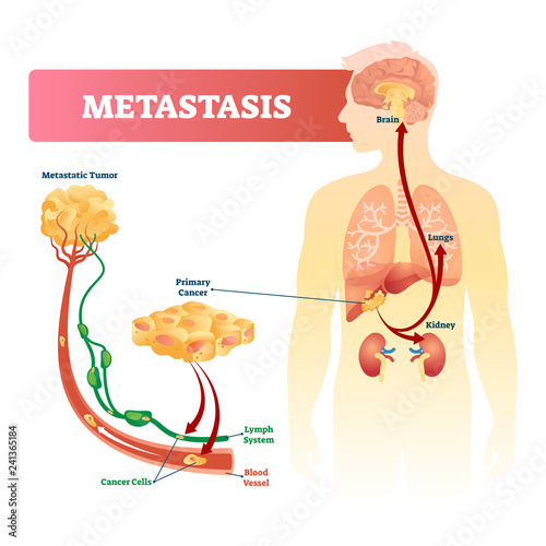 Metastasis vector illustration. Primary cancer and tumor labeled diagram.