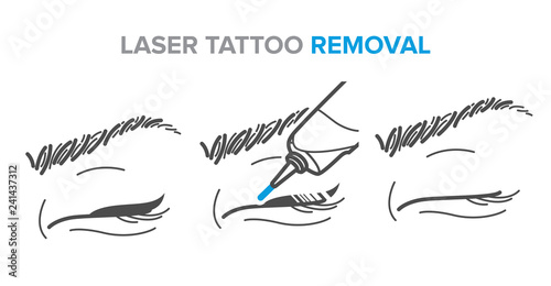 laser tattoo removal, permanent makeup removal, microblading