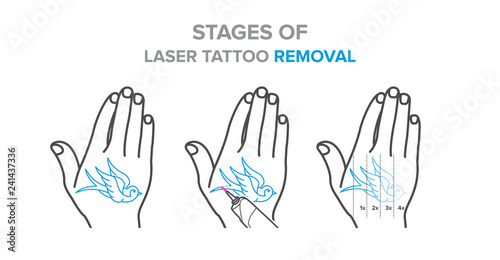 Stages of laser tattoo removal illustration, vector icons