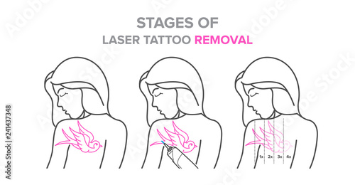 Stages of laser tattoo removal, vector illustrations