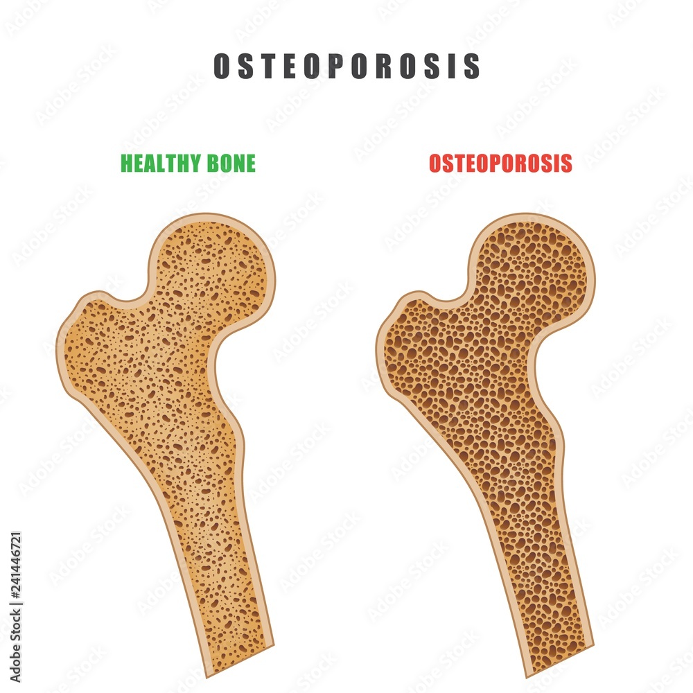 Color drawing of human thigh bone with osteoporosis problem on white