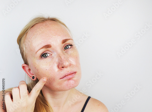 Oily and problem skin. Portrait of a blonde girl with acne, oily skin and pigmentation