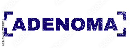 ADENOMA text seal print with distress texture. Text caption is placed between corners. Blue vector rubber print of ADENOMA with unclean texture.