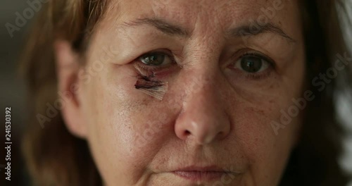 Close-up of sad older woman with bruised and scarred face looking to camera photo