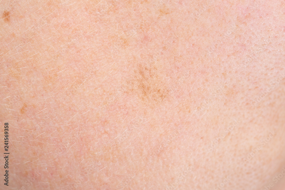 Closeup shot of skin blemishes Closeup shot of skin blemishes