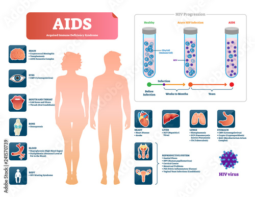 AIDS or HIV vector illustration. Labeled medical diagram with virus symptom