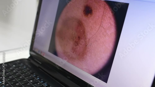 Image of a birthmark or warts close-up on a laptop monitor. Dermatology, dermatoscopy, prevention of melanoma, skin cancer.