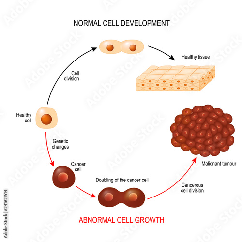 Cancer cell. illustration showing cancer disease development.