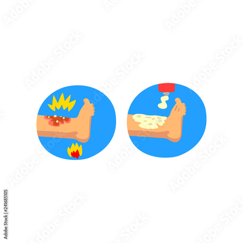 Thermal skin burn of leg, first aid and treatment vector Illustration on a white background