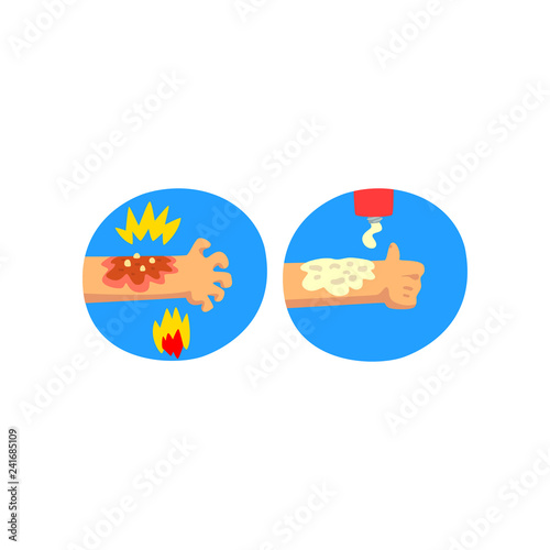 Thermal skin burn of hand, first aid and treatment vector Illustration on a white background