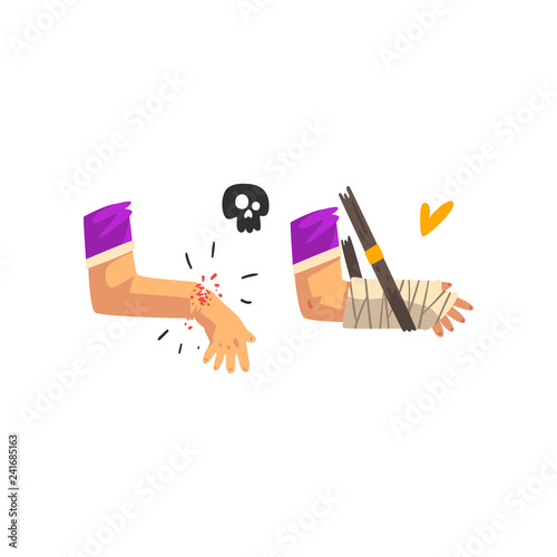 Fracture of the wrist, hand plastered, physical injury, first aid and treatment vector Illustration on a white background