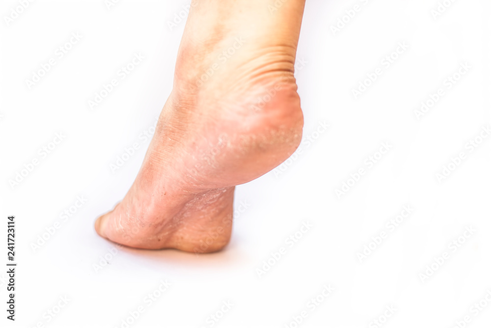 Close up of single female leg or heel showing dried cracked heel with dried skin isolated on white concept of crack heels during winter season.; Close up of single female leg or heel showing dried cracked heel with dried skin isolated on white concept of crack heels during winter season.;