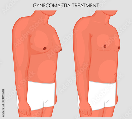 Vector illustration of gynecomastia in male before and after treatment. Man chest at half-turn (front and side view). For advertising of cosmetic plastic procedures, diet, medical publications
