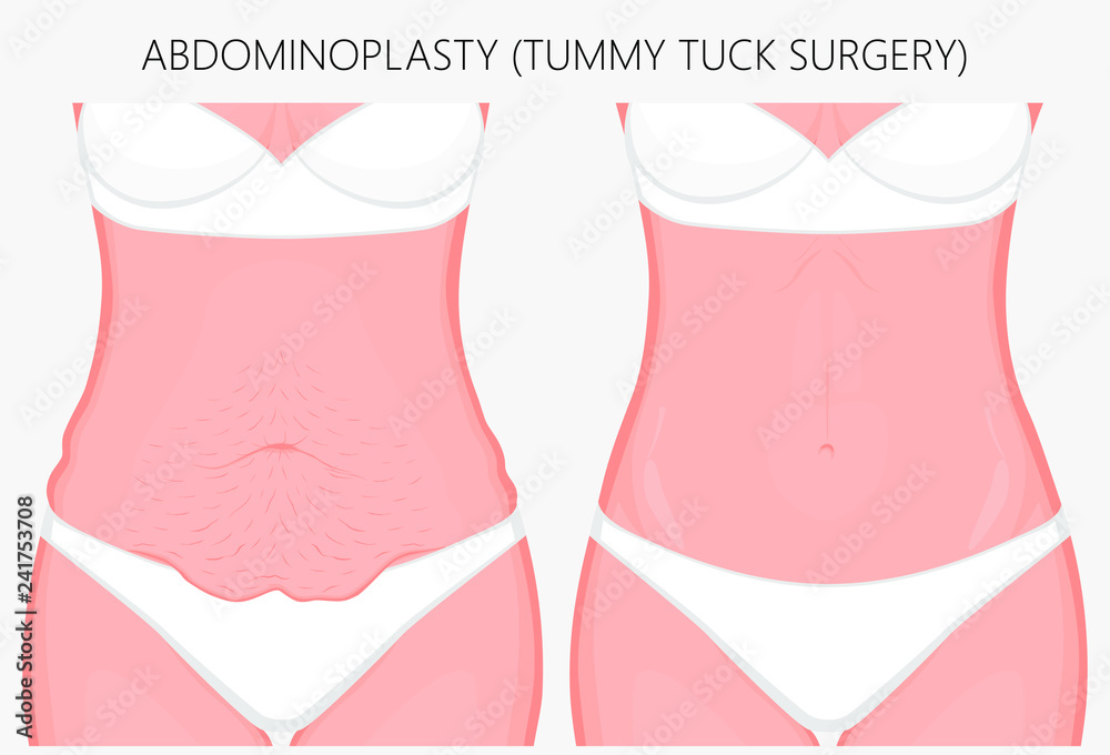 Realistic Vector illustration. Abdominoplasty, tummy tuck plastic