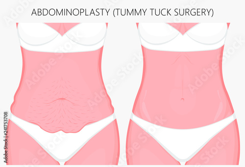 Realistic Vector illustration. Abdominoplasty, tummy tuck plastic surgery in woman. Front view. For advertising of cosmetic plastic procedures, stomach shunting, diet; for medical publications