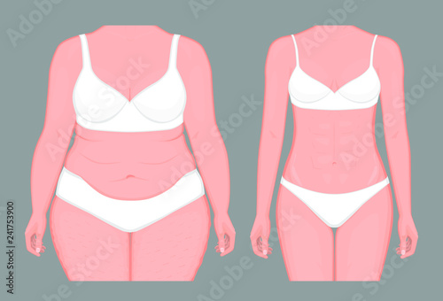Vector illustration. Woman body problem fat belly in European Asian female, weight loss to normal slim figure. Front view. For advertising of cosmetic plastic procedures, medical publications