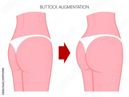 Vector illustration of a woman body. European, Asian female buttocks before and after augmentation. For advertising of cosmetic procedures, clinic of plastic surgery, medical publications