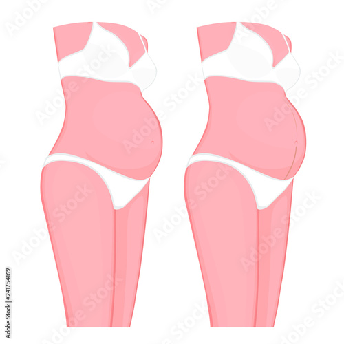 Vector illustration. Body problem. Pregnancy Line or Linea Nigra on European, Asian pregnant women belly. For advertising, medical publications, use on package of medicinal products, creams