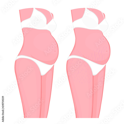 Vector illustration of human body problem. Stretch marks on European, Asian pregnant women belly and legs. For advertising, medical publications, use on package of medicinal products, creams