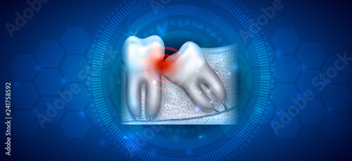 Wisdom tooth eruption problems on an abstract blue background
