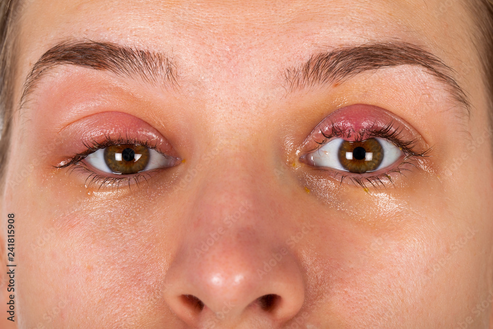 upper-eyelid-infection-chalazion-stock-photo-adobe-stock