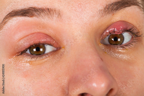 Upper eyelid infection - chalazion