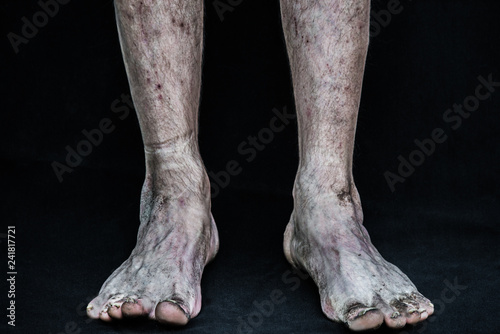 Dirty homeless drug addict legs with necrosis, gangrene, trombosis and death of tissue traces