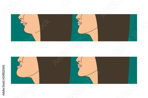 bite correction by braces