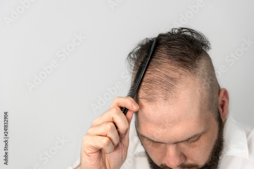 young man combs his thinning hair